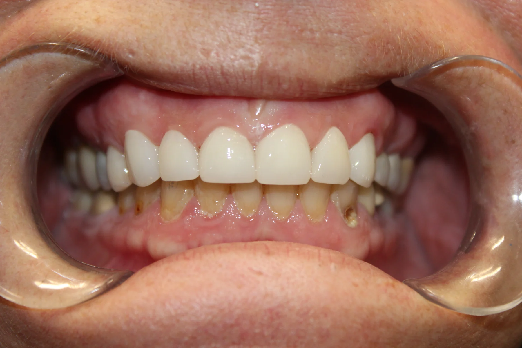 Flex Dental patient smile after treatment