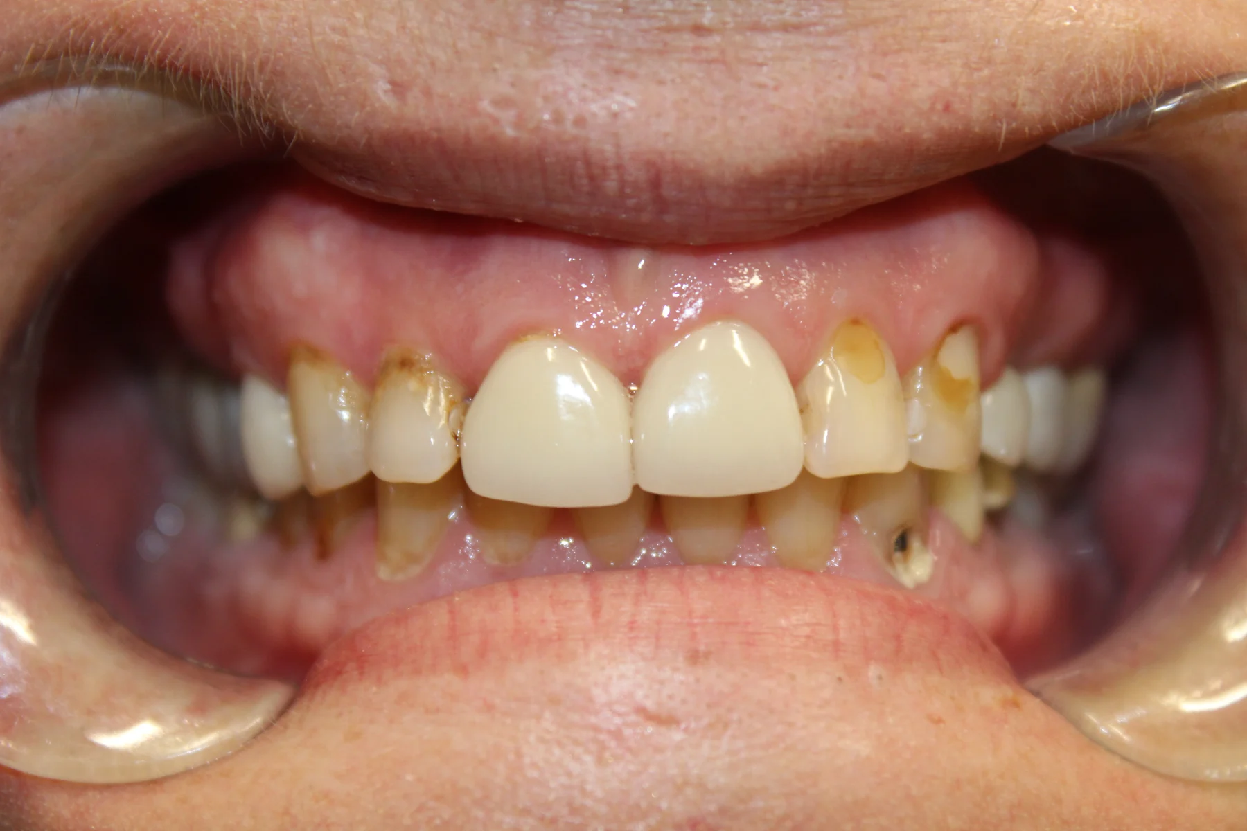 Flex Dental patient smile before treatment
