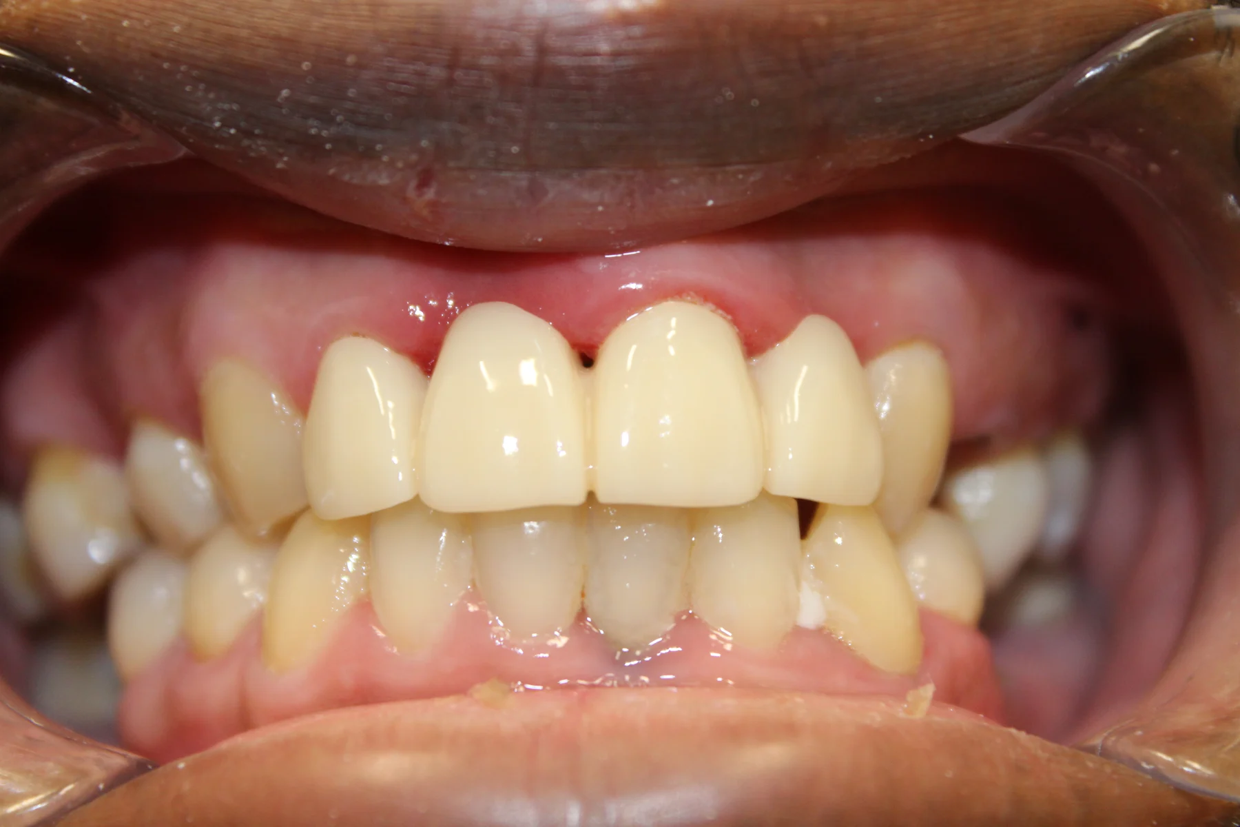 Flex Dental patient smile after treatment