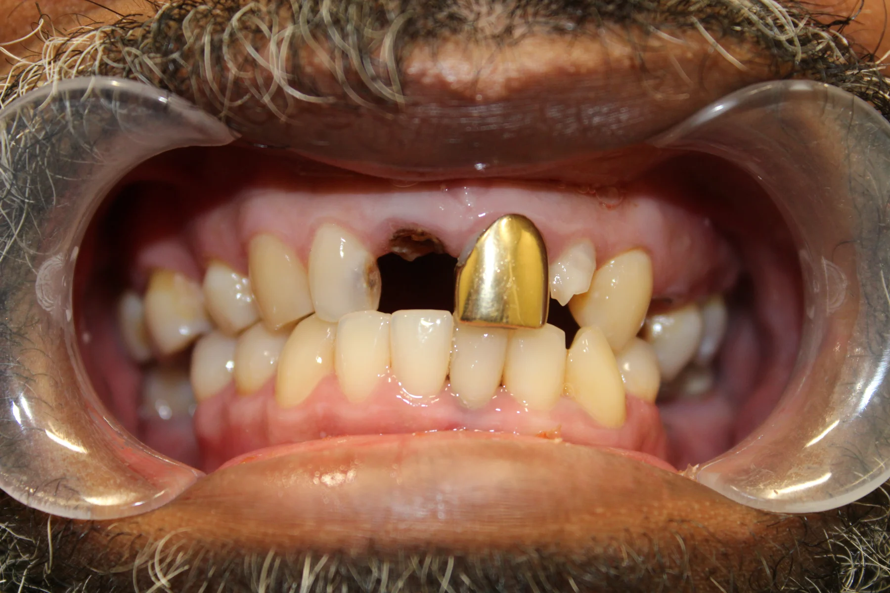 Flex Dental patient smile before treatment
