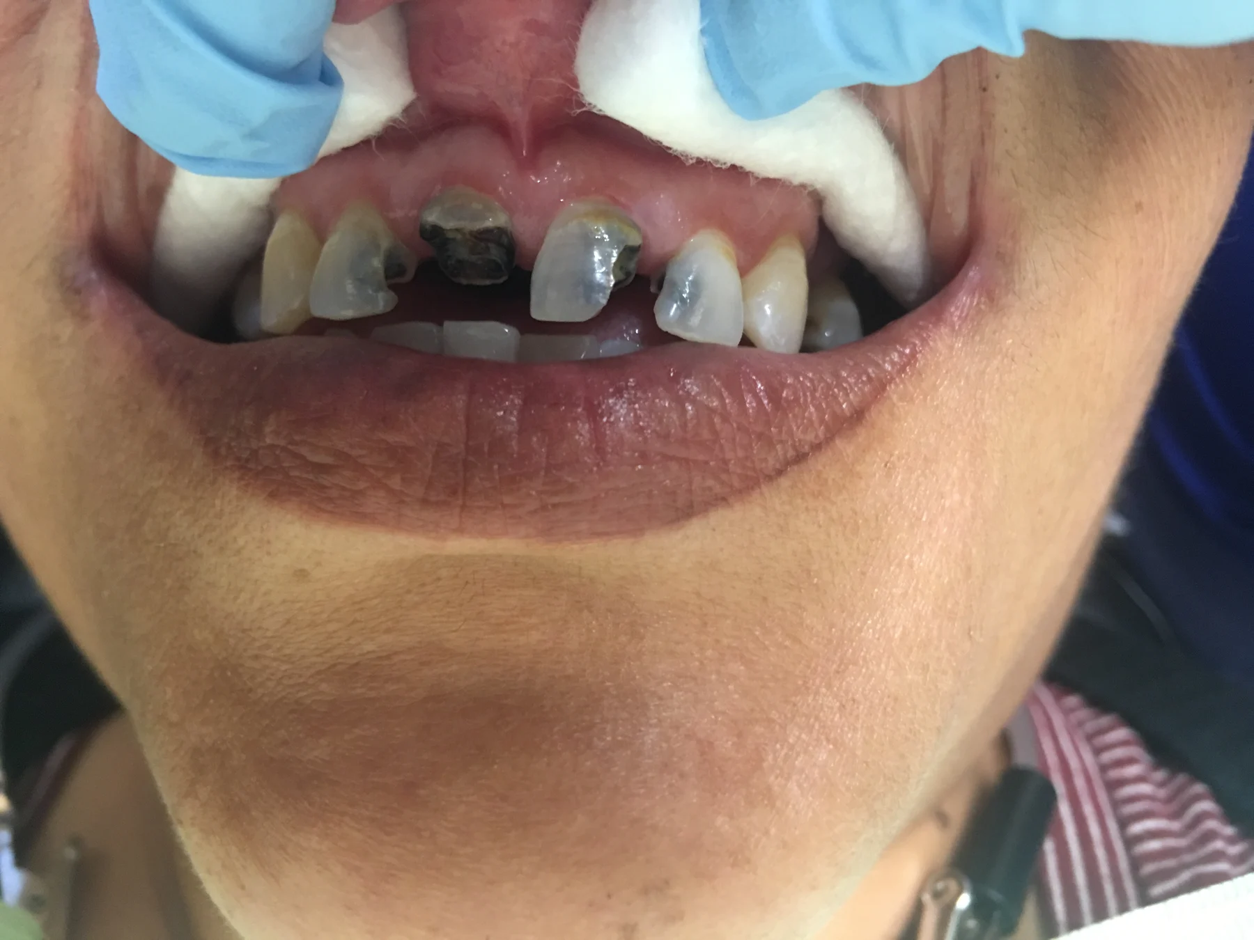 Flex Dental patient smile before treatment