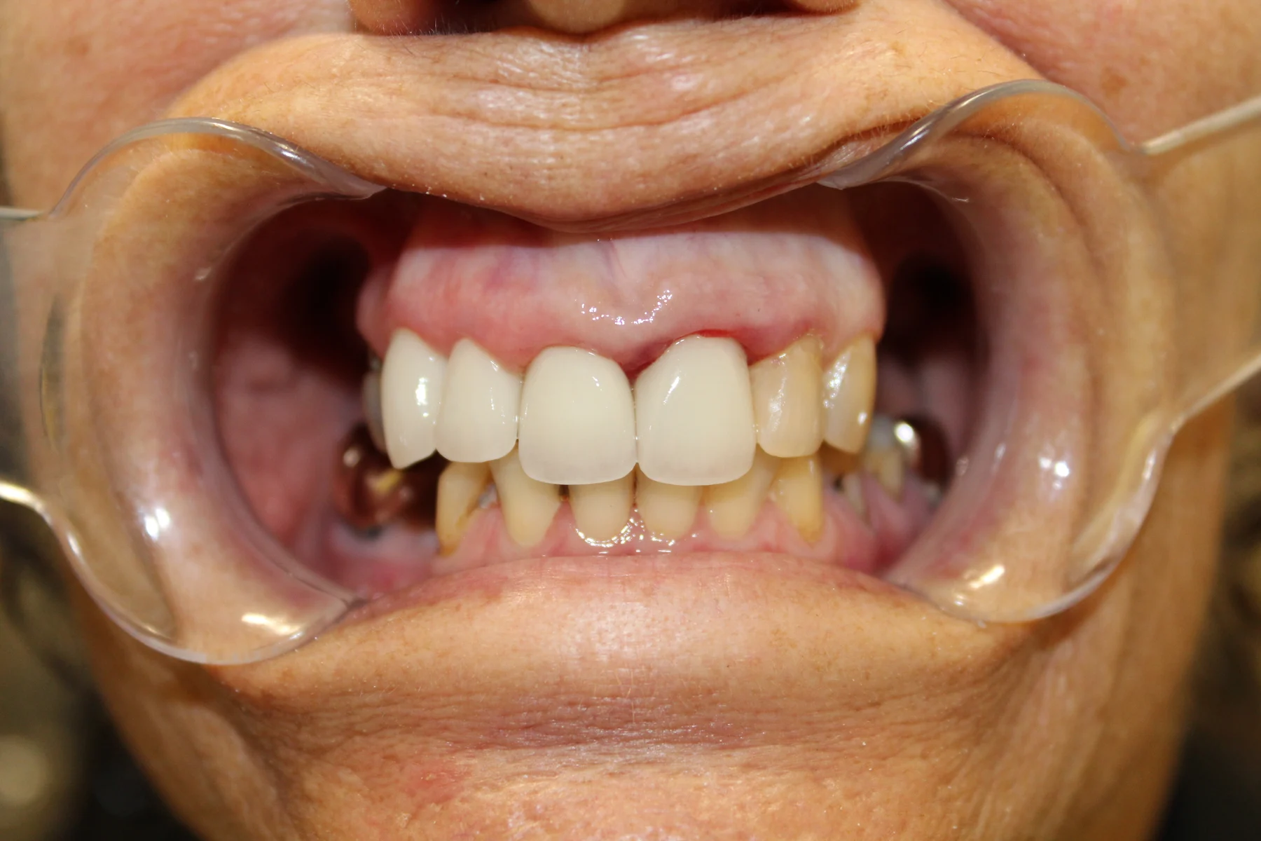 Flex Dental patient smile after treatment
