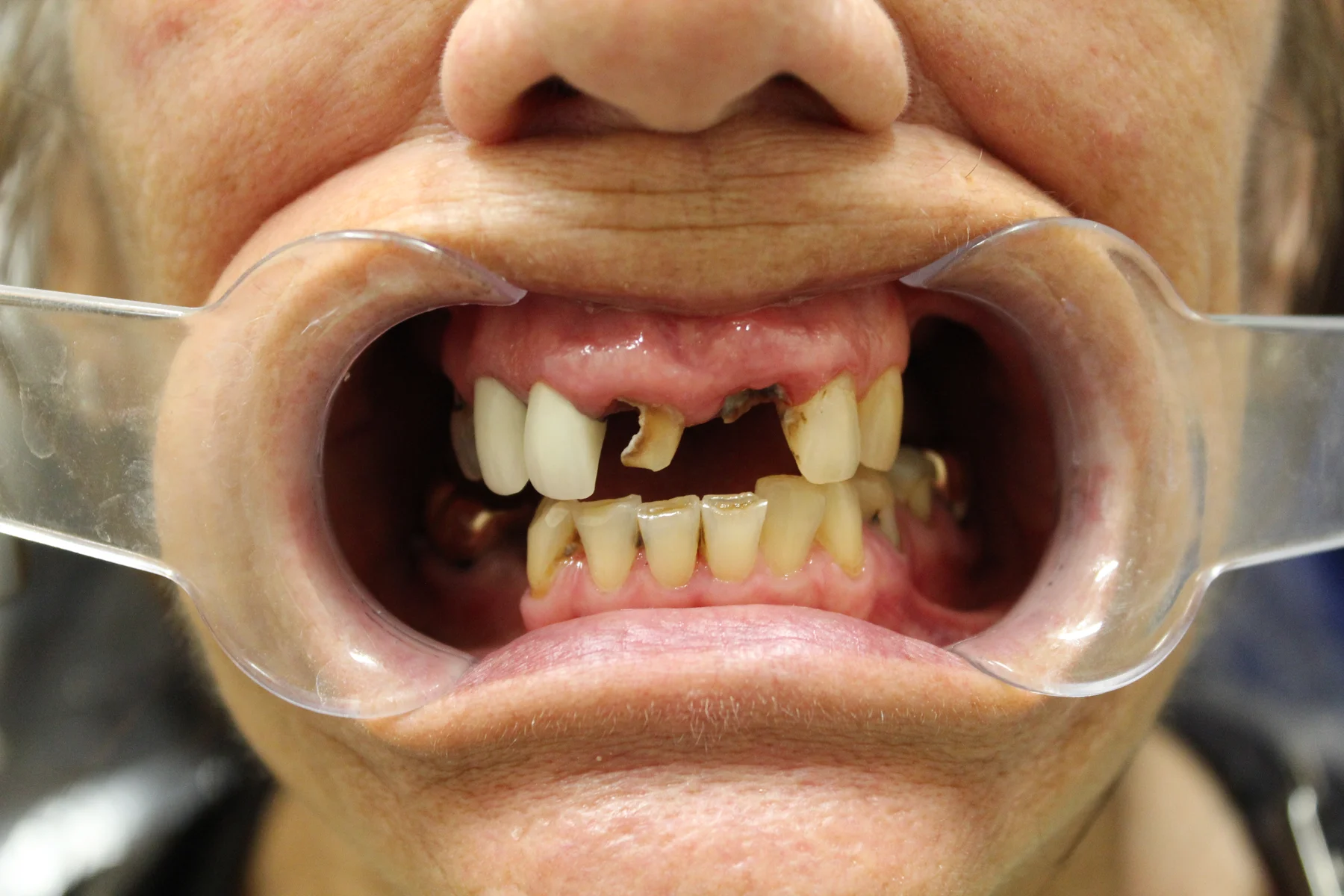 Flex Dental patient smile before treatment