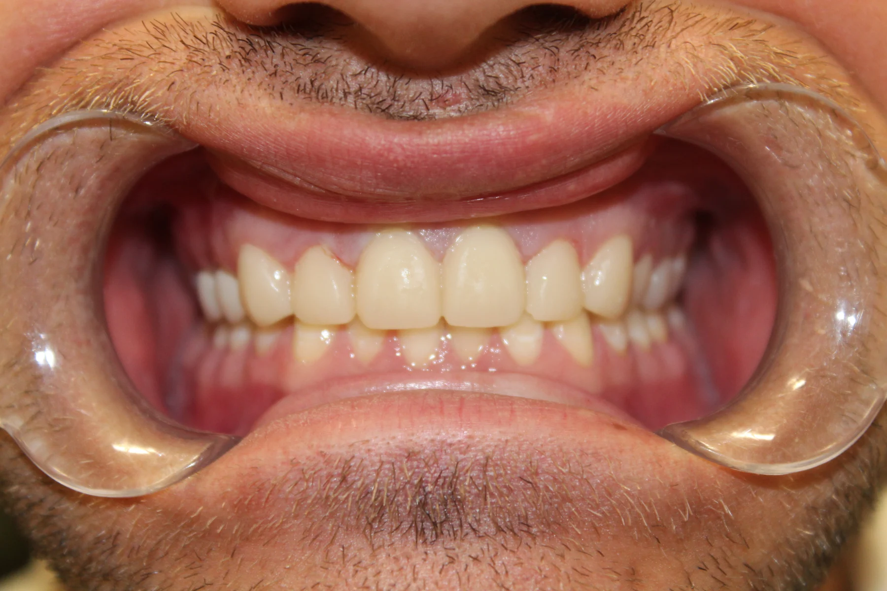 Flex Dental patient smile after treatment