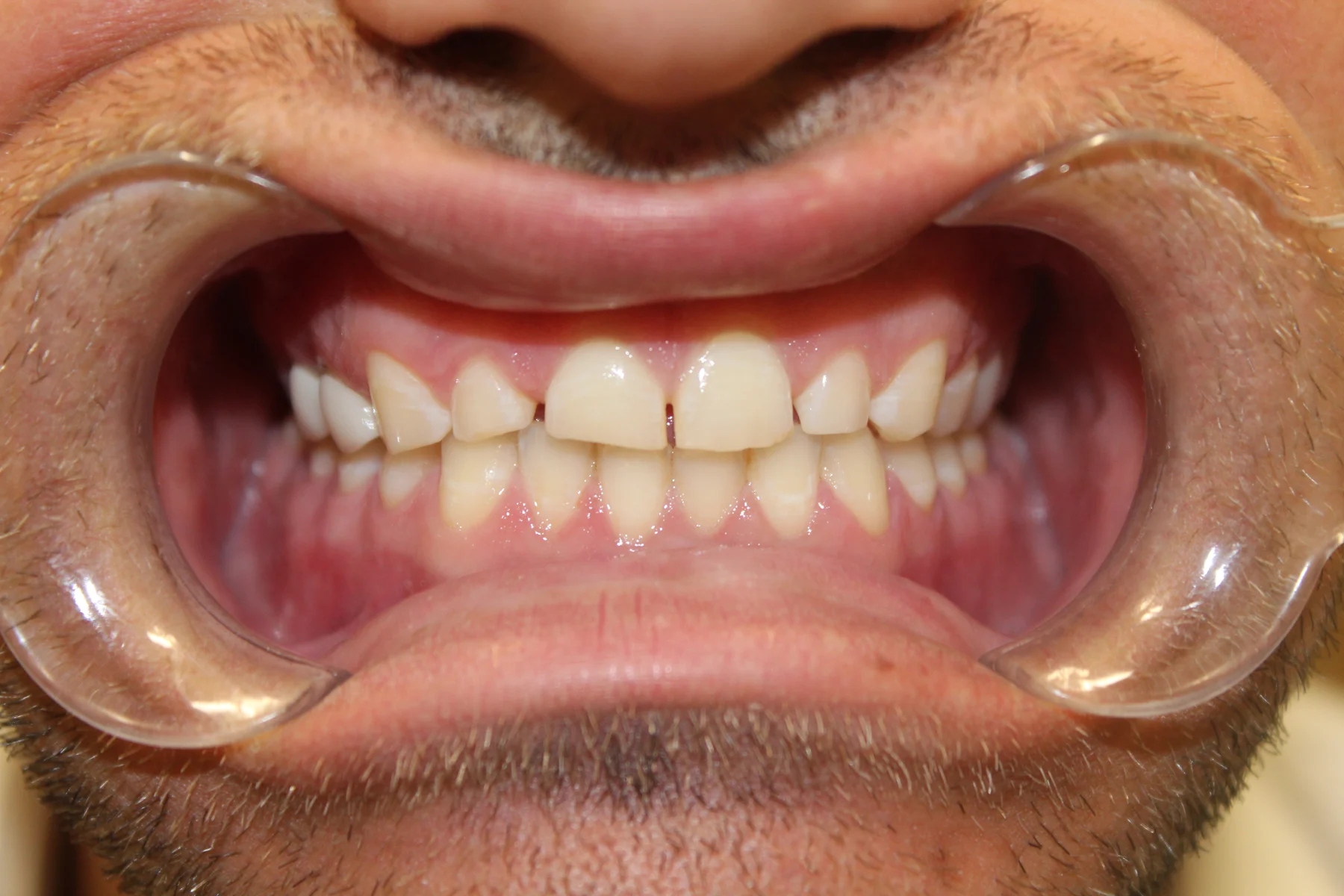 Flex Dental patient smile before treatment