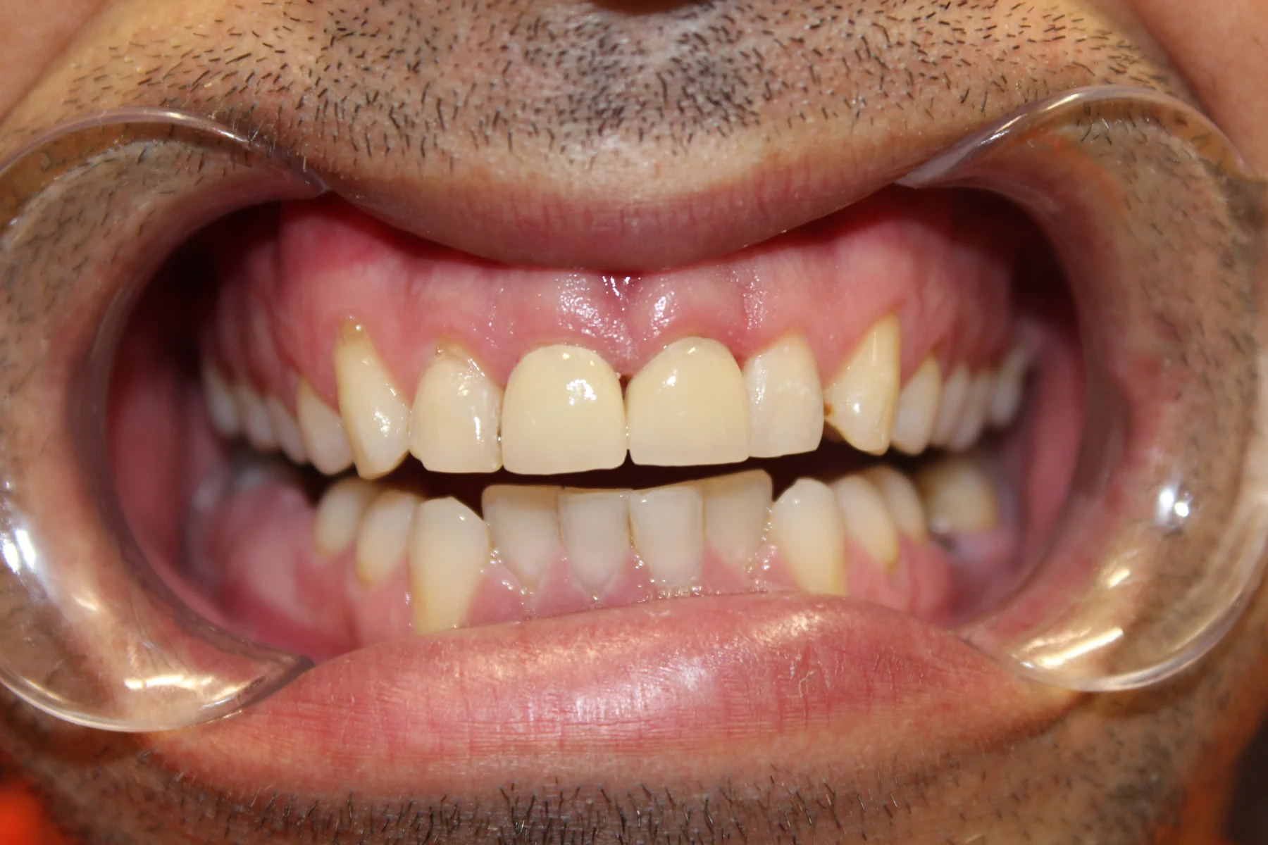 Flex Dental patient smile after treatment