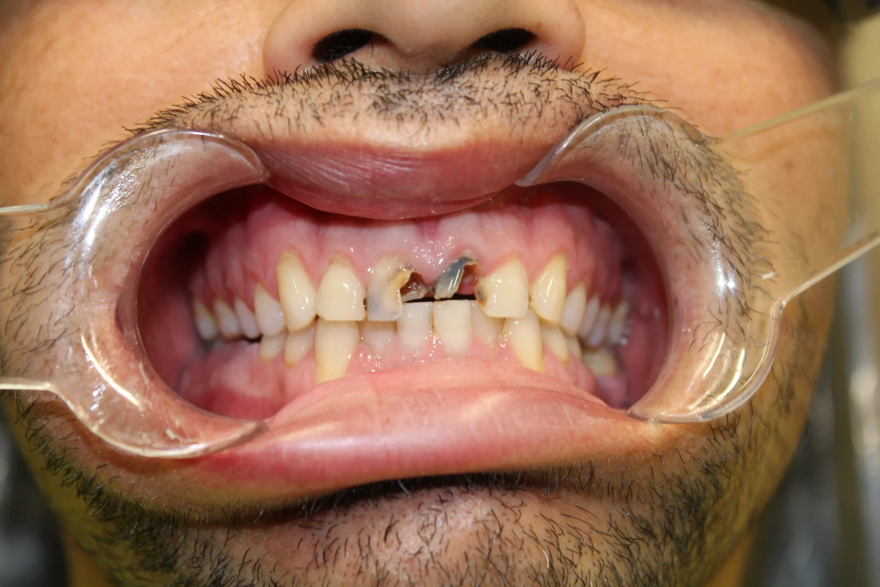 Flex Dental patient smile before treatment